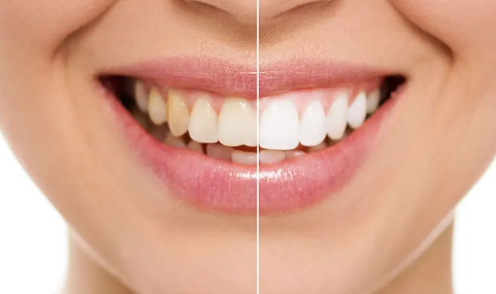 طرق علاج تصبغات الأسنان Tooth discoloration