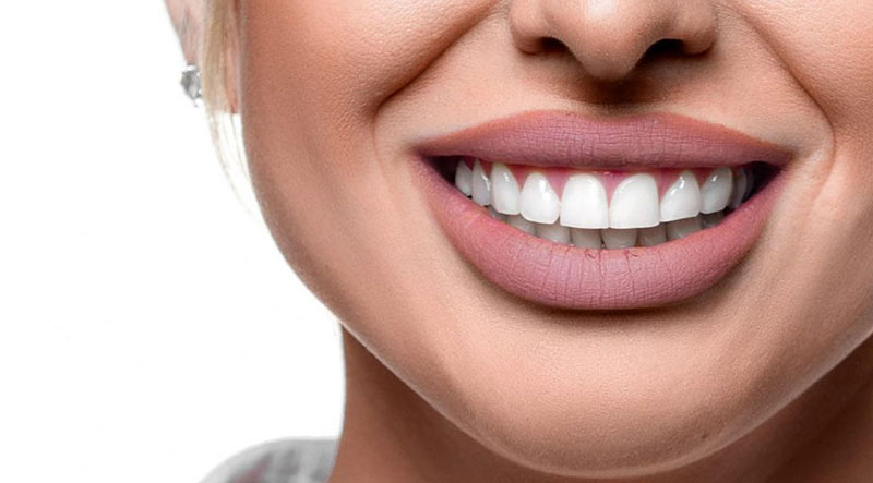 ابتسامة هوليوود: كيف تحصل على ابتسامة المشاهير؟