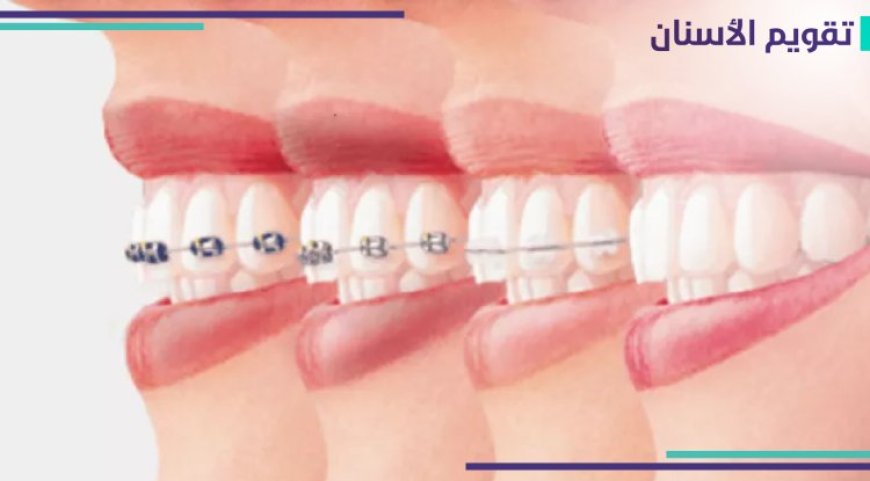 تقويم الاسنان