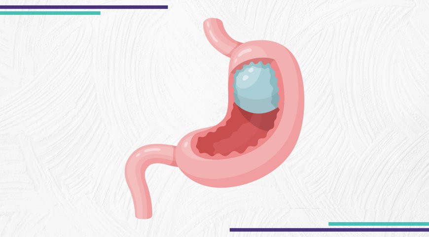 بالون المعدة