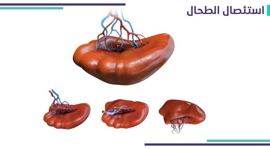 استئصال الطحال